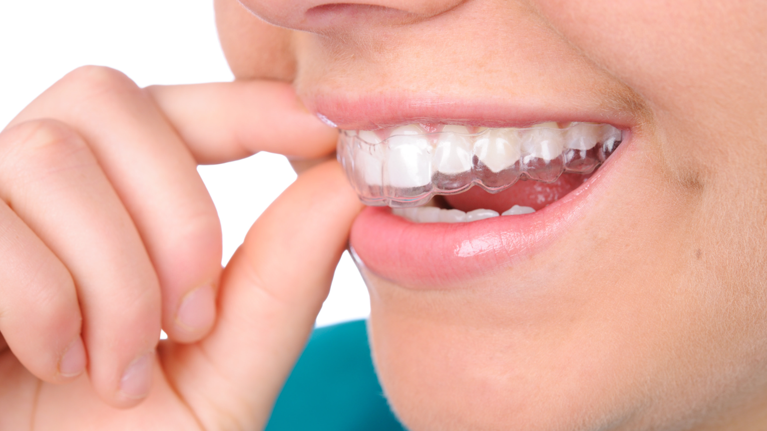 How to Care for Your Retainers: Essential Tips for a Healthy Smile